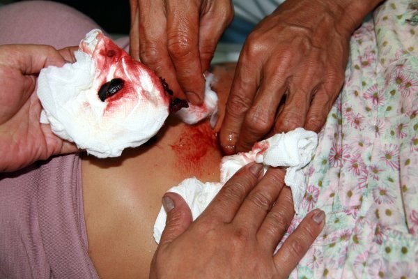Psychic surgery