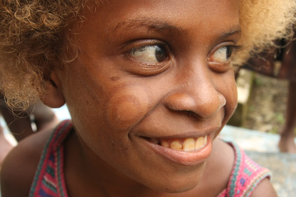 Facial scarification